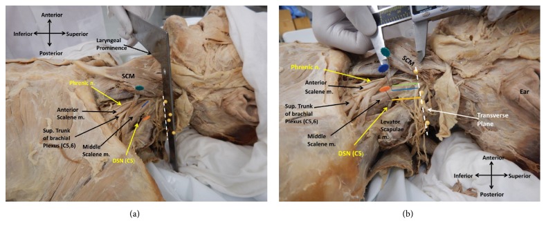 A Cadaveric Investigation of the Dorsal Scapular Nerve.