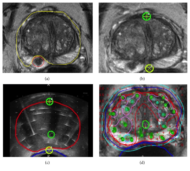 Systematic Review of Focal Prostate Brachytherapy and the Future Implementation of Image-Guided Prostate HDR Brachytherapy Using MR-Ultrasound Fusion.