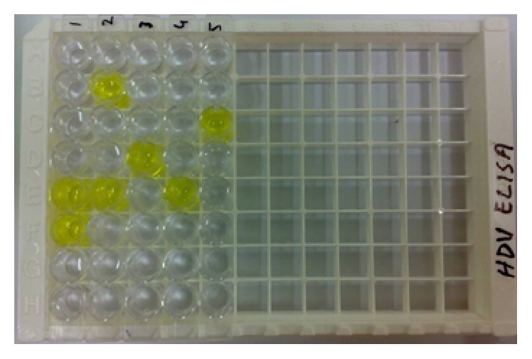 PCR-Based Molecular Diagnosis of Hepatitis Virus (HBV and HDV) in HCV Infected Patients and Their Biochemical Study.