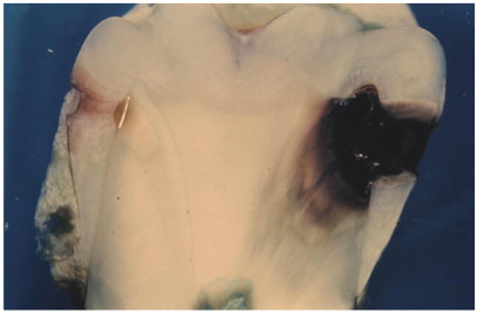 Dental Calculus Arrest of Dental Caries.