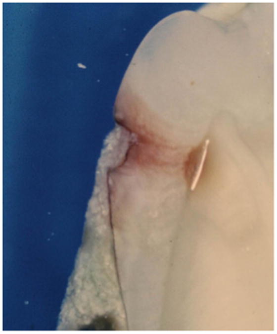 Dental Calculus Arrest of Dental Caries.