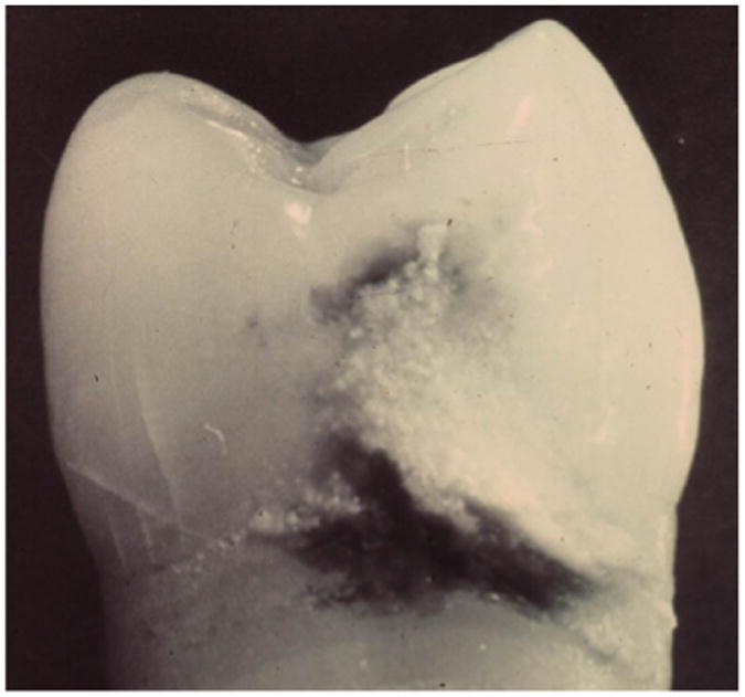 Dental Calculus Arrest of Dental Caries.