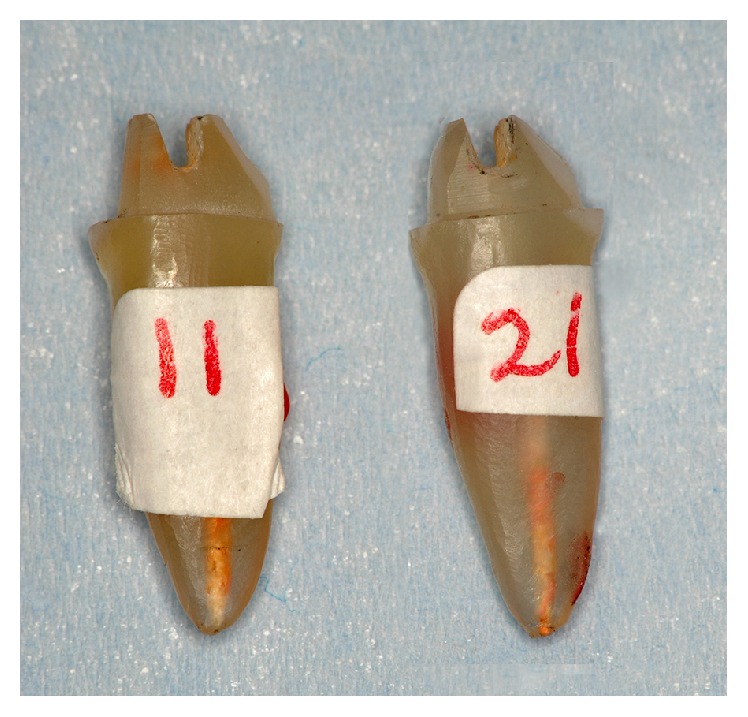 Impact of a Core Ferrule Design on Fracture Resistance of Teeth Restored with Cast Post and Core.