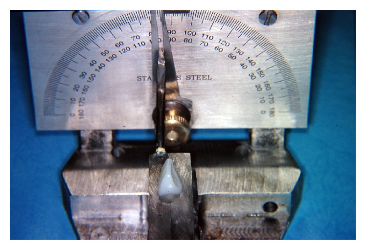 Impact of a Core Ferrule Design on Fracture Resistance of Teeth Restored with Cast Post and Core.