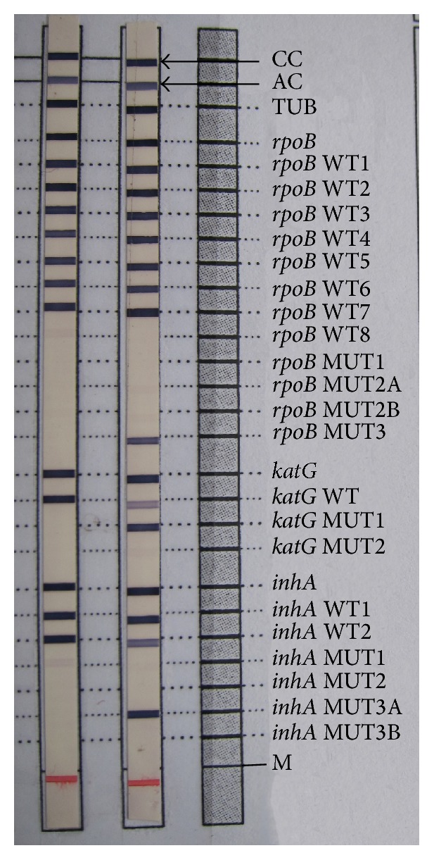 Primary Multidrug Resistant Tuberculosis and Utility of Line Probe Assay for Its Detection in Smear-Positive Sputum Samples in a Tertiary Care Hospital in South India.