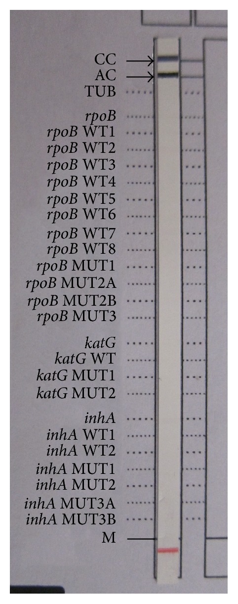 Primary Multidrug Resistant Tuberculosis and Utility of Line Probe Assay for Its Detection in Smear-Positive Sputum Samples in a Tertiary Care Hospital in South India.