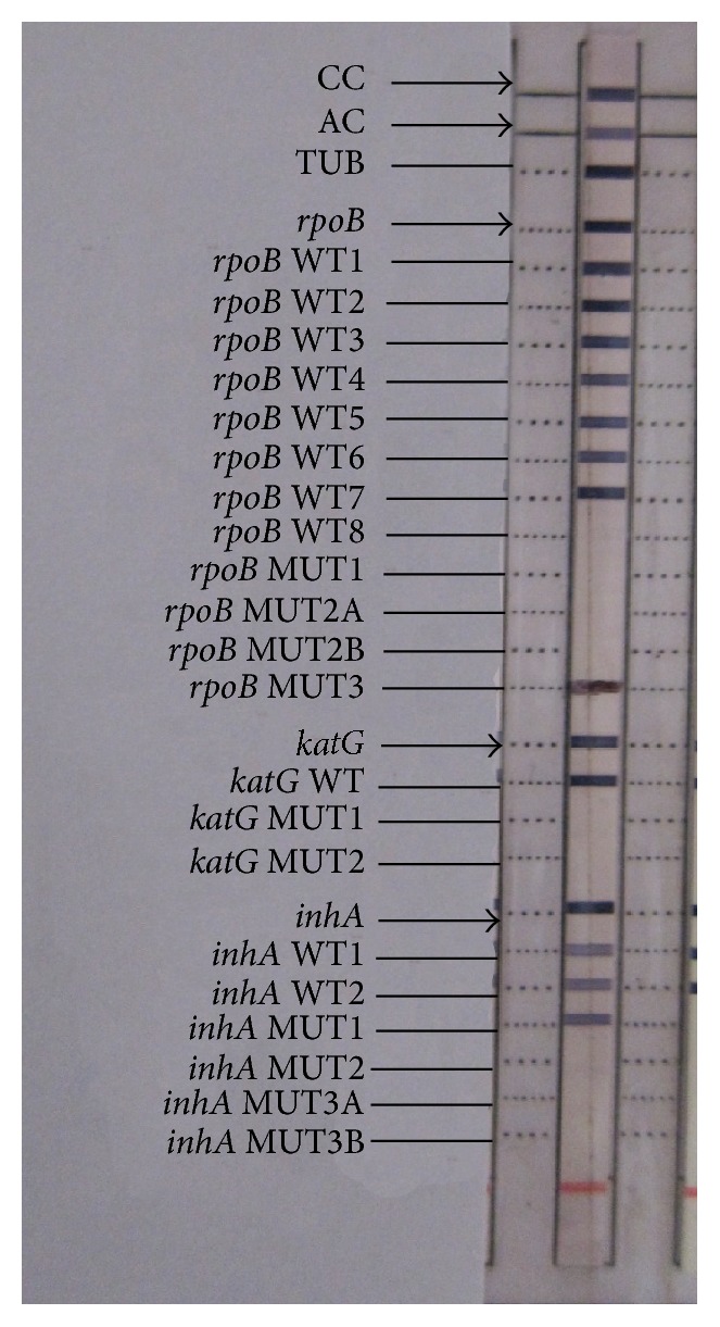 Primary Multidrug Resistant Tuberculosis and Utility of Line Probe Assay for Its Detection in Smear-Positive Sputum Samples in a Tertiary Care Hospital in South India.