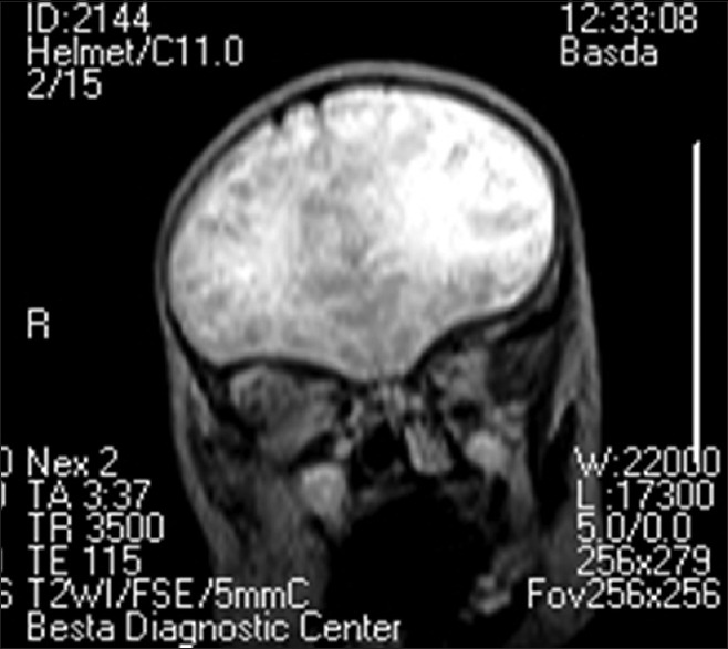 Neonatal Airway Obstruction from an Immature Teratoma: The Challenge of Appropriate Investigation in a Low-Resource Setting.