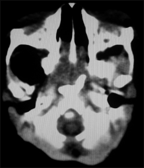 Neonatal Airway Obstruction from an Immature Teratoma: The Challenge of Appropriate Investigation in a Low-Resource Setting.