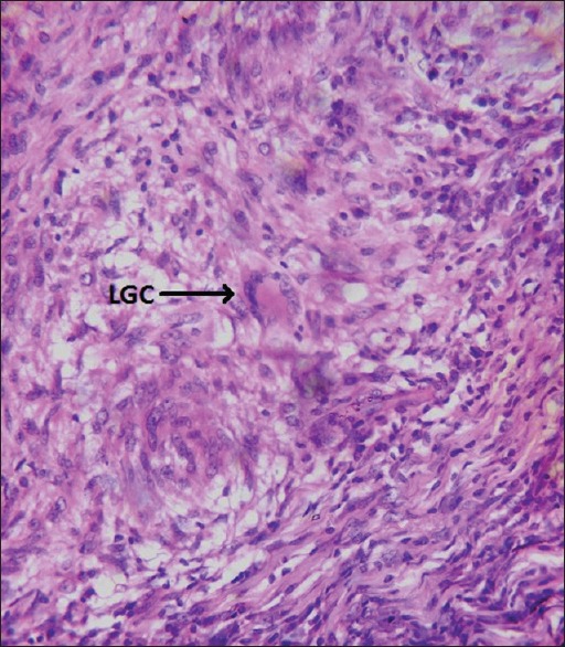 Tuberculous Lymphadenitis in South-Eastern Nigeria; A 15 Years Histopathologic Review (2000-2014).