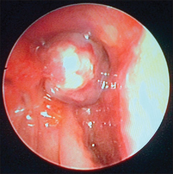 Neonatal Airway Obstruction from an Immature Teratoma: The Challenge of Appropriate Investigation in a Low-Resource Setting.