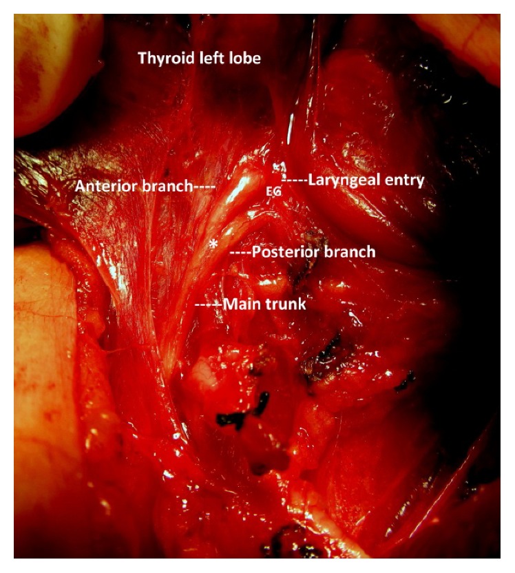 Morphology and Functional Anatomy of the Recurrent Laryngeal Nerve with Extralaryngeal Terminal Bifurcation.