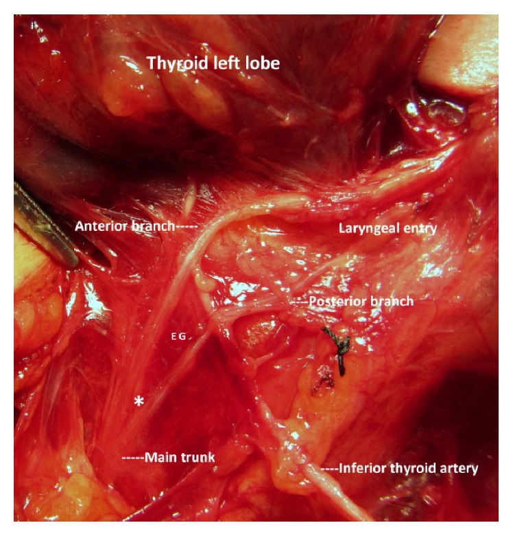 Morphology and Functional Anatomy of the Recurrent Laryngeal Nerve with Extralaryngeal Terminal Bifurcation.