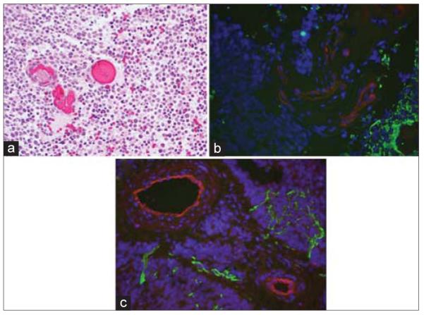 Characterization of the blood brain barrier in pediatric central nervous system neoplasms.