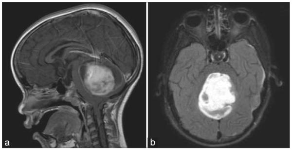 Characterization of the blood brain barrier in pediatric central nervous system neoplasms.