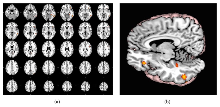 How Extended Is Wernicke's Area? Meta-Analytic Connectivity Study of BA20 and Integrative Proposal.