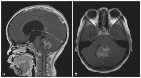 Characterization of the blood brain barrier in pediatric central nervous system neoplasms.