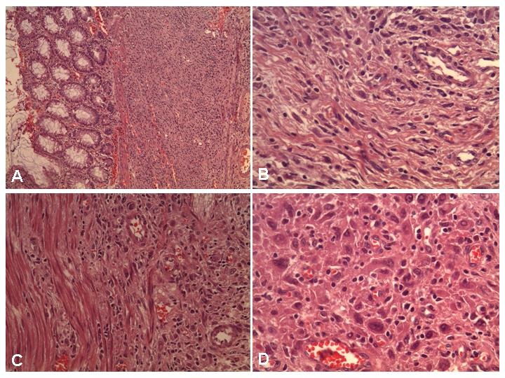 Gastrointestinal Autonomic Nerve Tumor of the Colon: A Rare Cause of Persistent Abdominal Pain in a Child.