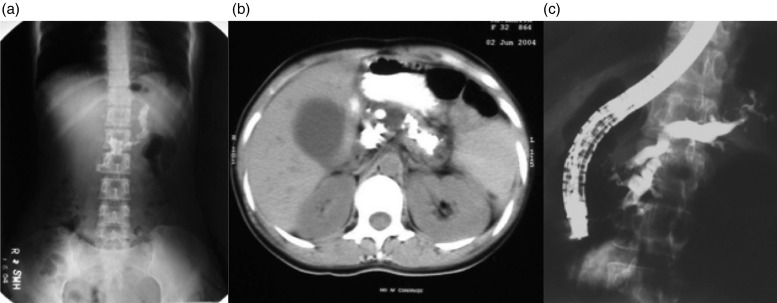 Changing phenotype and disease behaviour of chronic pancreatitis in India: evidence for gene-environment interactions.