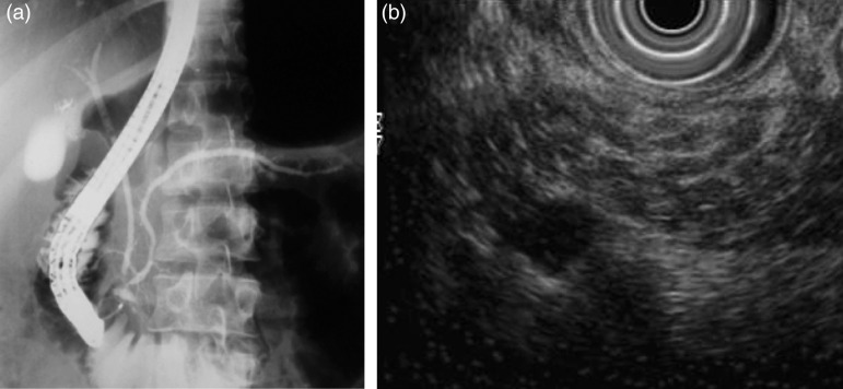 Changing phenotype and disease behaviour of chronic pancreatitis in India: evidence for gene-environment interactions.