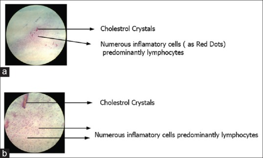Nonsurgical endodontic therapy along with minimal invasive treatment utilizing Bhasker's hypothesis for the management of infected radicular cystic lesion: A rare case report.