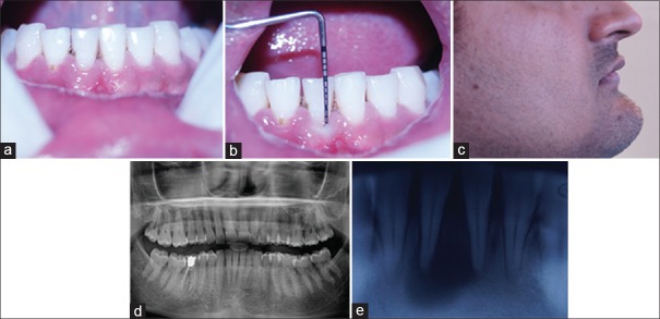 Nonsurgical endodontic therapy along with minimal invasive treatment utilizing Bhasker's hypothesis for the management of infected radicular cystic lesion: A rare case report.