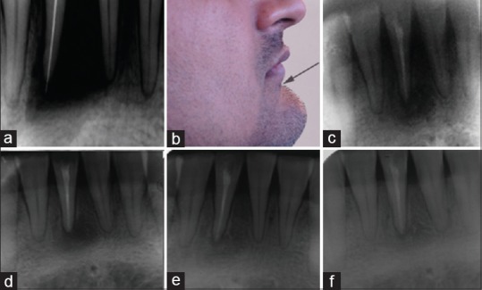 Nonsurgical endodontic therapy along with minimal invasive treatment utilizing Bhasker's hypothesis for the management of infected radicular cystic lesion: A rare case report.