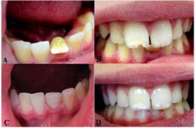 A Case Report of Dilacerated Crown of a Permanent Mandibular Central Incisor.