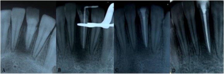 A Case Report of Dilacerated Crown of a Permanent Mandibular Central Incisor.