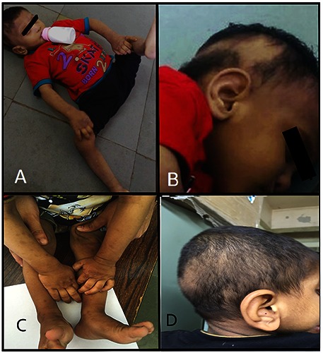 A Child with Debilitating Pruritus.