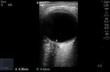 A unique method for estimating the reliability learning curve of optic nerve sheath diameter ultrasound measurement.