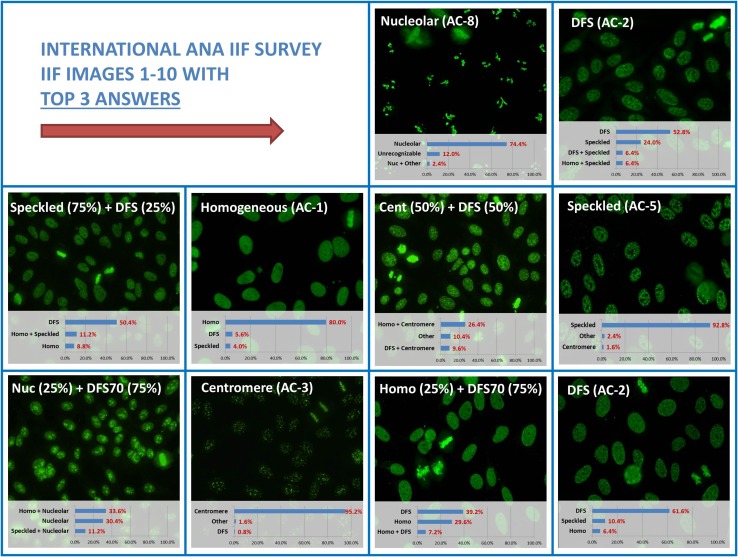 Recognition of the dense fine speckled (DFS) pattern remains challenging: results from an international internet-based survey.