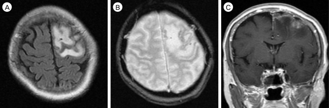 Spontaneous Aggressive Conversion of Venous Drainage Pattern in Dural Arteriovenous Fistula Treated with Onyx Embolization.