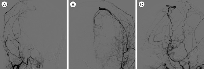 Spontaneous Aggressive Conversion of Venous Drainage Pattern in Dural Arteriovenous Fistula Treated with Onyx Embolization.