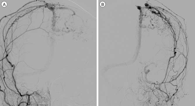 Spontaneous Aggressive Conversion of Venous Drainage Pattern in Dural Arteriovenous Fistula Treated with Onyx Embolization.