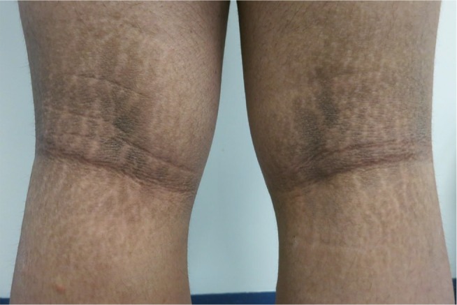 Acanthosis nigricans in obese adolescents: prevalence, impact, and management challenges.