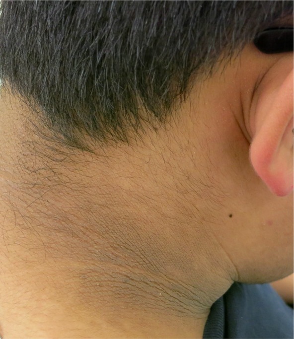Acanthosis nigricans in obese adolescents: prevalence, impact, and management challenges.