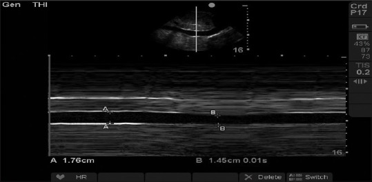 Comparative evaluation of central venous pressure and sonographic inferior vena cava variability in assessing fluid responsiveness in septic shock.
