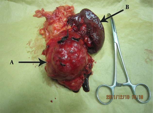 Pancreatic Lymphangioma as a Rare Pancreatic Mass: A Case Report.