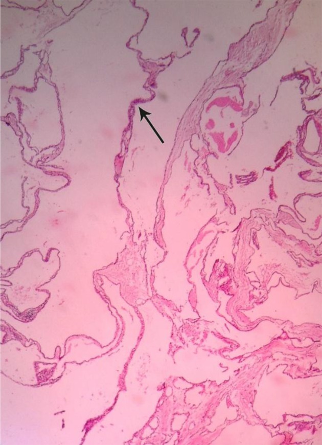 Pancreatic Lymphangioma as a Rare Pancreatic Mass: A Case Report.