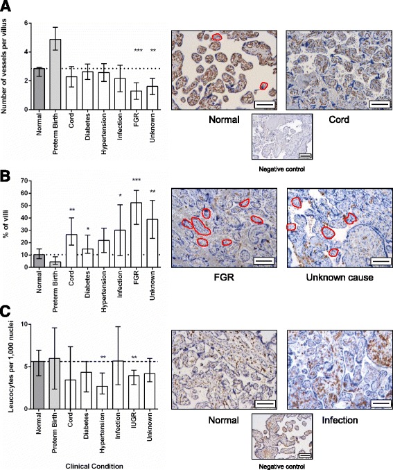 Quantitative assessment of placental morphology may identify specific causes of stillbirth.