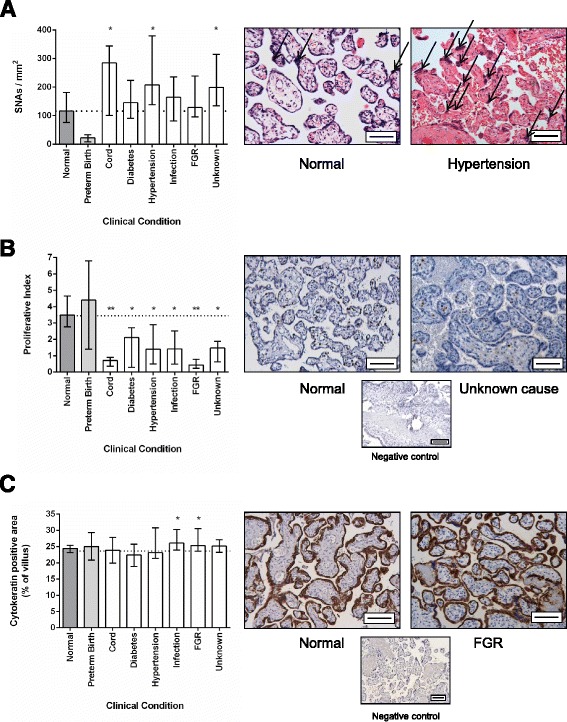 Quantitative assessment of placental morphology may identify specific causes of stillbirth.