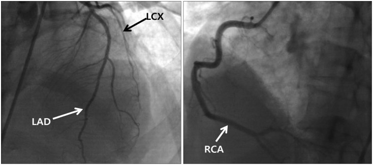 Stress-Induced Cardiomyopathy Presenting as Shock.