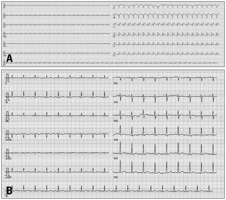 Stress-Induced Cardiomyopathy Presenting as Shock.