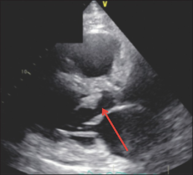 Acute Severe Aortic Regurgitation: Imaging with Pathological Correlation.