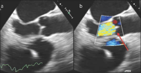 Acute Severe Aortic Regurgitation: Imaging with Pathological Correlation.