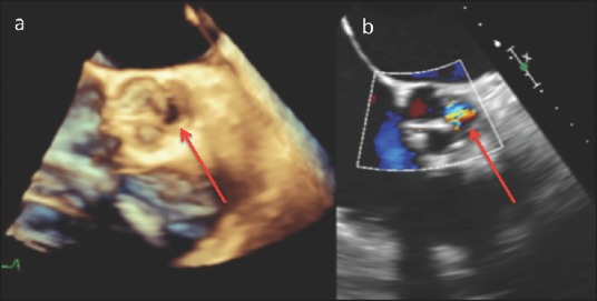 Acute Severe Aortic Regurgitation: Imaging with Pathological Correlation.