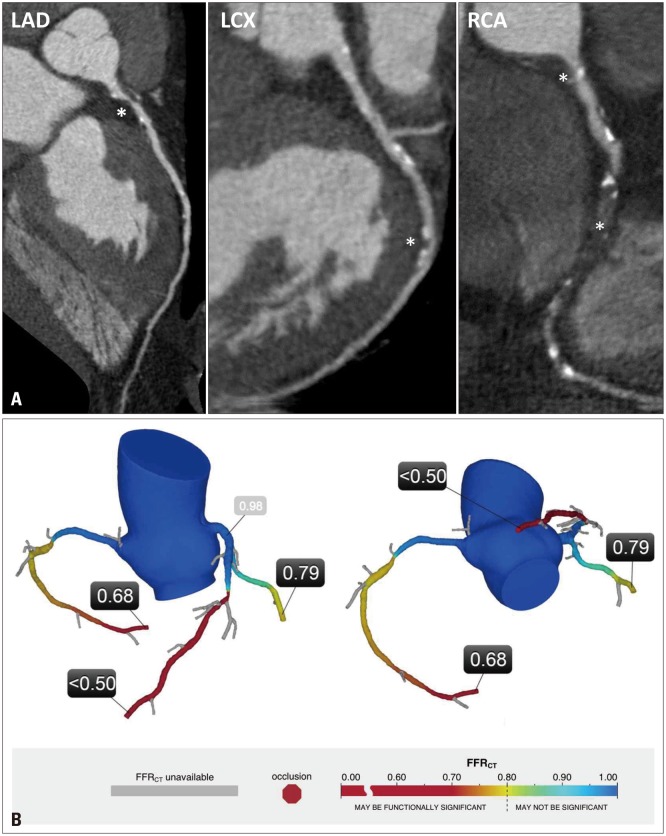 Multimodality Imaging in Coronary Artery Disease: Focus on Computed Tomography.