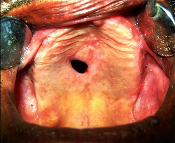 Suction Cup Induced Palatal Fistula: Surgical Closure by Palatal Rotational Flap.