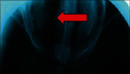 Suction Cup Induced Palatal Fistula: Surgical Closure by Palatal Rotational Flap.